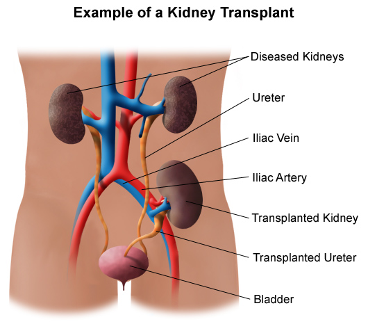 Kidney Stone Surgery